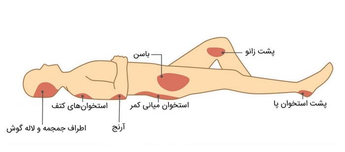 نواحی مستعد زخم بستر در بدن